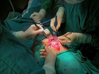 Surgery of abdominal, Resection of Small Bowels with Ligation of vessels during operation. Step by step surgery.
