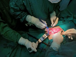 Surgery of abdominal, Resection of Small Bowels with Ligation of vessels during operation. Step by step surgery.