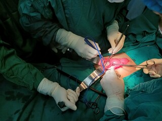 Surgery of abdominal, Resection of Small Bowels with Ligation of vessels during operation. Step by step surgery.