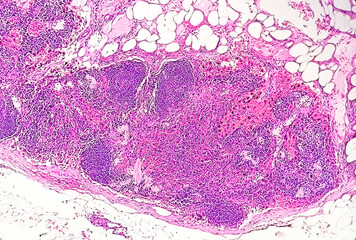Photomicrograph of Pelvic node histology showing Free of Metastasis, means that cancer has not...