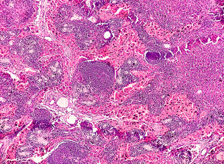 Photomicrograph of Pelvic node histology showing Free of Metastasis, means that cancer has not...