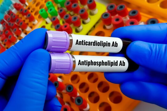 Blood sample tubes for antiphospholipid Antibody and Anti Cardiolipin antibody test, diagnosis for autoimmune disease APS.