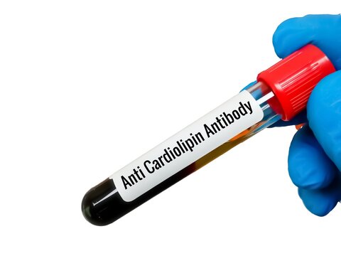 Blood sample tube for Anti Cardiolipin antibody test, antiphospholipid syndrome (APS), autoimmune disease
