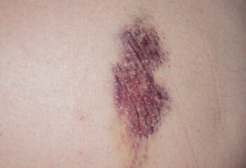 Fototapeta premium Hematoma. Bruise on body. Closeup Bruise on body. Close up on a bruise. Violence, victim. Bruise wounded skin texture.