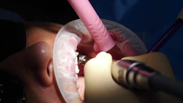 Dentist wearing gloves is using a dental drill on a patient's teeth. The patient's mouth is open and a cheek retractor is holding it open. Dental healyhcare clinic concept. 4 k video