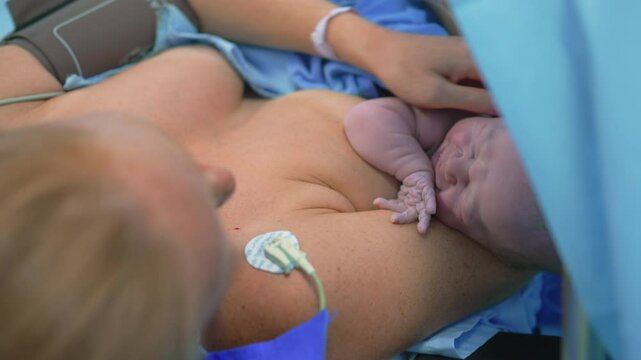 A just-born baby is placed on the mother's chest as the surgeon completes the cesarean section operation. A touching moment of maternal bonding, love, and the first embrace after childbirth in a