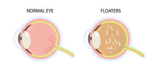 Cross section of eye with floaters vector illustration. Particles show shadows problem vision concept © Kakigori Studio