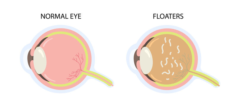 Cross section of eye with floaters vector illustration. Particles show shadows problem vision concept