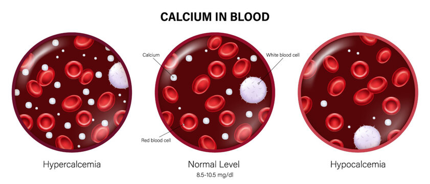 Hypercalcemia, Normal level and Hypocalcemia. Calcium in blood vector. Compare blood calcium levels.