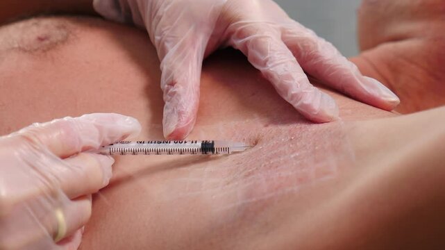 Medical professional wearing latex gloves performing injection with a syringe into a patient skin of armpit, showcasing vital healthcare practices within a clinical environment. hyperhidrosis