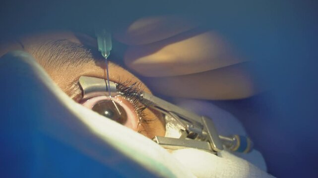 Close-up of delicate ophthalmic surgery, laser procedure, intraocular lens insertion, corneal correction, precise surgical instruments, and focus on vision restoration in an advanced medical setting