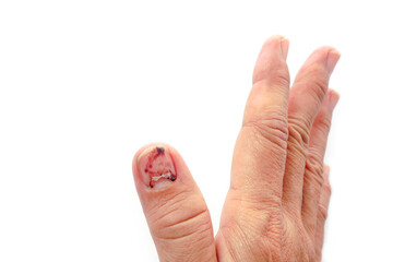 Thumb Finger with Bruised Nail, Subungual Hematoma, on White Background. Painful bruises, accident,...