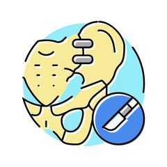 joint fusion surgery color icon vector. joint fusion surgery sign. isolated symbol illustration