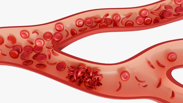 a 3d rendering of blood vessel with a cluster of sickle cells obstructing the flow of blood. Sickle cells are are rigid and sticky, causing them to clump together and block blood flow. 