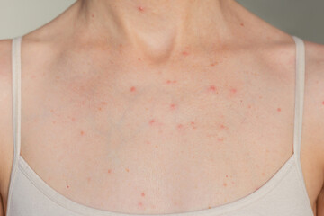 Close-up photo of a young woman suffering acne in the chest and neck. Skin diseases. Hormonal disorders. 
