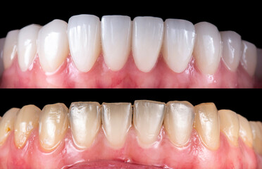 Obraz premium ceramic crowns and veneers before and after picture