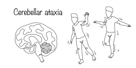 Cerebellar ataxia