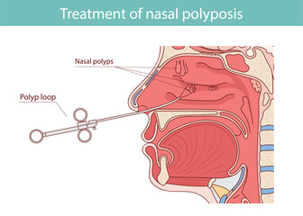 Nasal Polyps Diagram: Anatomy of the nasal cavity, sinuses, mouth, turbinates and polyps. Medical vector illustration