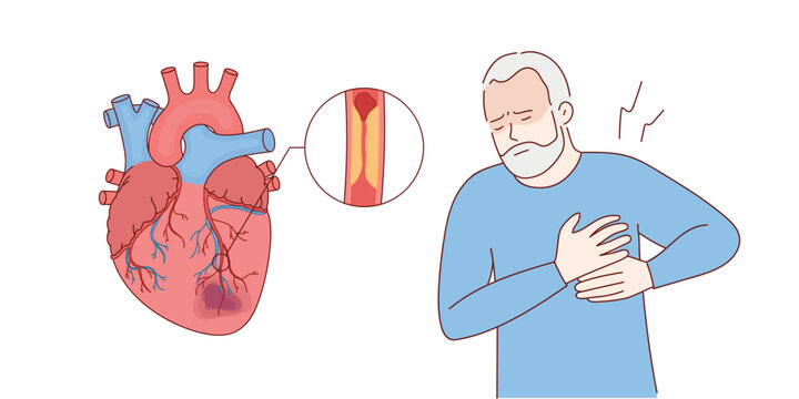 Myocardial infarction. Illustration of a human heart. Heart attack. Illustration in cartoon style