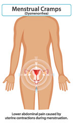 Understanding Menstrual Cramps and Dysmenorrhea