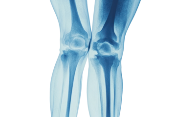 X-ray of knees focusing on joint health, detecting injuries or degenerative diseases, isolated on transparent and white background.PNG image	
 