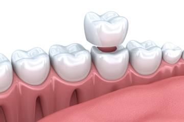 Dental Crown Placement: 3D model of a dental crown being placed on a tooth.  High-quality, detailed image ideal for dental websites and educational materials. 