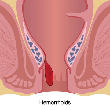 Hemorrhoids are swollen veins in the lower rectum and anus.