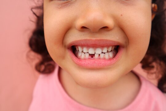 An Asian female toddler shows her newly knocked out teeth and looks toothless, close up.
