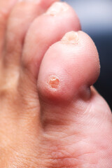 This image shows a close up of a persons foot with a wart found on the toe