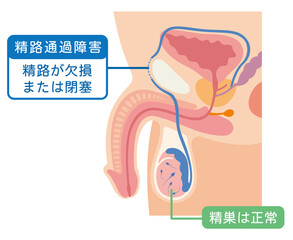 Fototapeta premium 精路通過障害 精路が欠損または閉塞 男性不妊