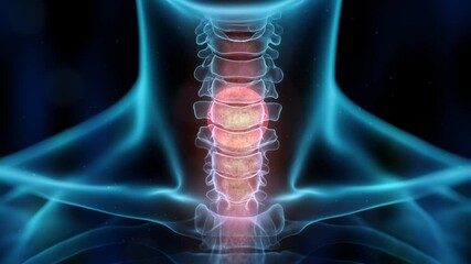 Human throat and thyroid highlighted in red. Relevant throat pain and inflammation, thyroid cancer awareness, hormonal imbalances, and endocrine diseases