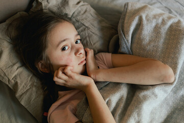 A sick child with skin rashes in bed. Child's skin with many red spot. Allergic reaction, Drug...