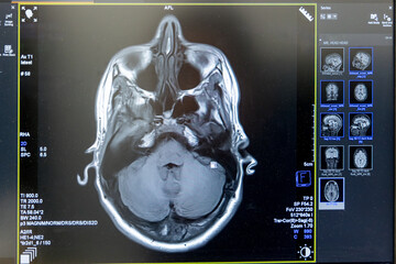 MRI brain scan. Medical, science and education mri brain. Magnetic resonance. MRI blood vessels...