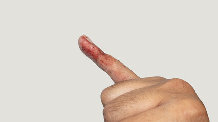 Close up of Bloody Finger Injury