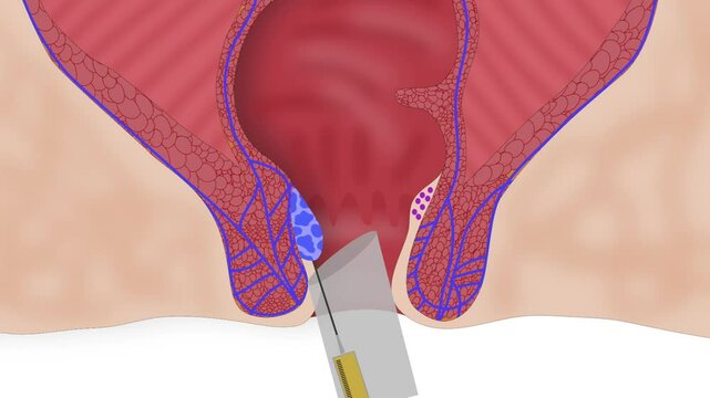 Sclerotherapy of the hemorrhoid node