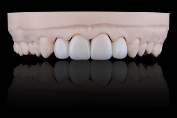 Four dental ultra-thin ceramic veneers in bleach color for fixation to frontal teeth of upper jaw. © gorynvd
