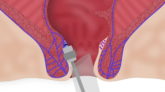 Latex leadership of the hemorrhoidal node