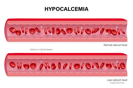 Hypocalcemia vector. Comparison between Normal calcium level and Low calcium level. Calcium in blood vessel.