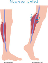 Skeletal Muscle pump effect. Illustration of muscle pump effect on venous return and muscle blood. Calf Muscles contracted and relaxed