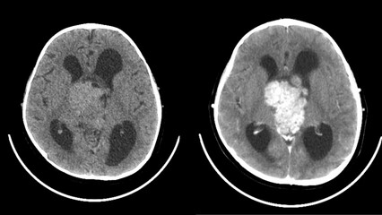 ependymoma , intraventricular mass head ct scan