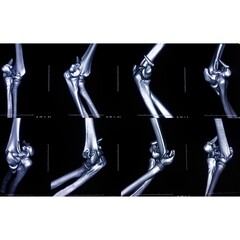 CT scan of an elbow joint showing dislocation and fracture after an accident female patient. film x-ray. medical concept.