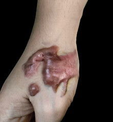 Keloid Scar on Human Hand