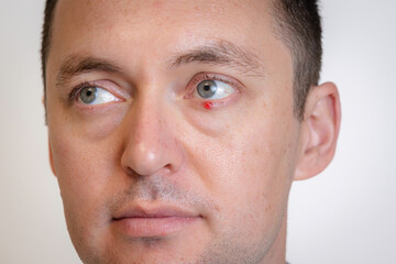 Obraz premium Man's eyes with pus redness like chalazion caused by blocked sebaceous glad on lower eyelid. Hordeolum. Viral infection