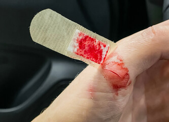 Bleeding wound on the thumb finger of the left hand. The man was injured by negligence at work. A...