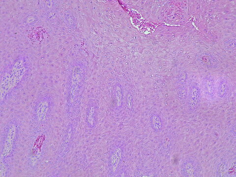 Photomicrograph of verruca vulgaris in the dextra pedis region under a microscope in the anatomical pathology laboratory