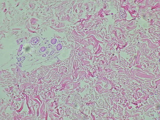tumor regio thoracalis posterior, microscopic image of a dermatofibroma, benign tumor in the...
