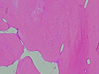 Photomicrograph of osteoma soft tissue tumor in anatomical pathology laboratory