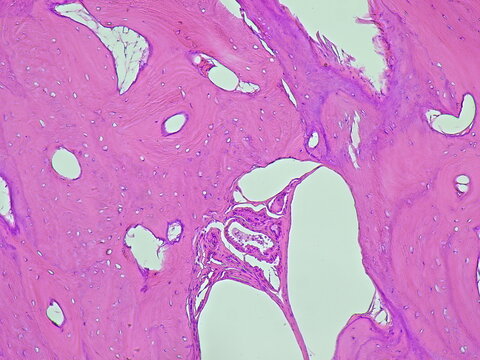 Photomicrograph of osteoma soft tissue tumor in anatomical pathology laboratory