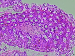 Ulcerative colitis photomicrograph in anatomical pathology laboratory