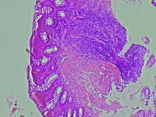 Ulcerative colitis photomicrograph in anatomical pathology laboratory